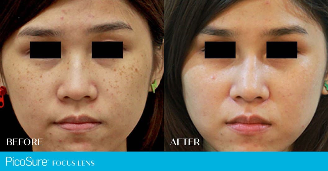 Picosure-before-after