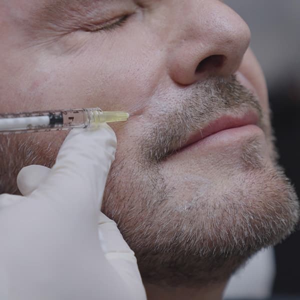 Nasolabial-fold-injection-needle