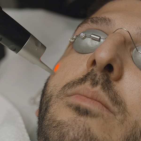 Picosure-laser-cheek-skin