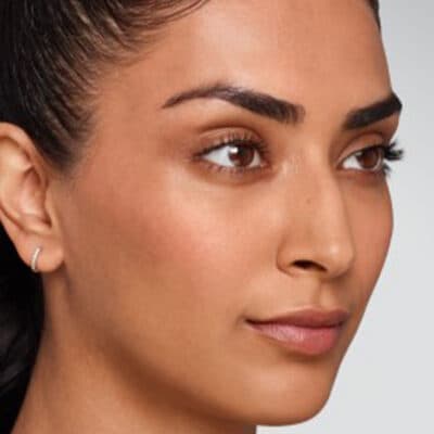 before-after-juvederm