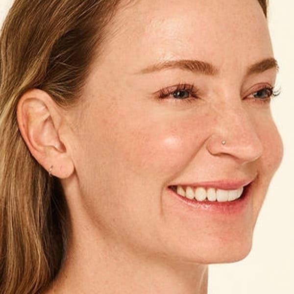 after-botox-Mandy