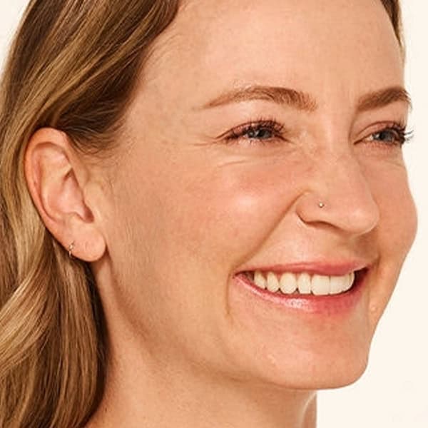before-botox-Mandy