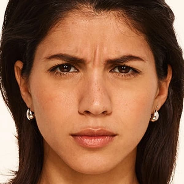 botox-before-Nicole-frown