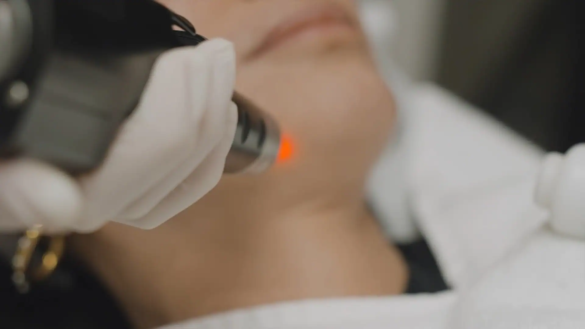 picolaser-treatment