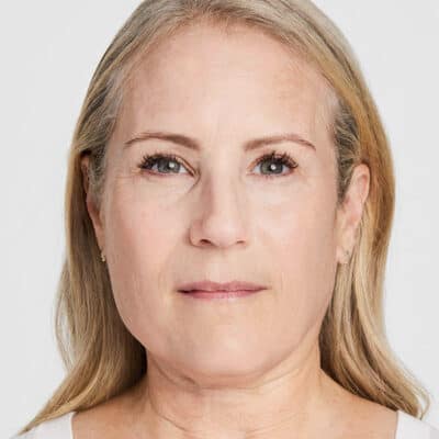 debbie-after-60days-ultherapy
