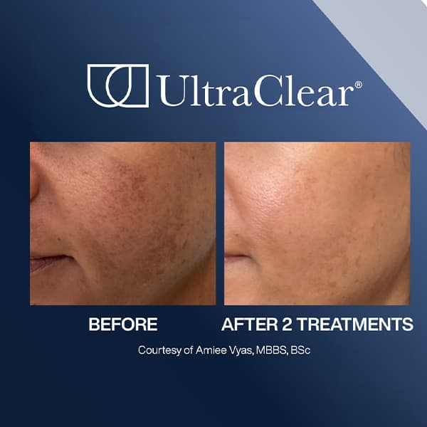 Ultraclear-before-after-1