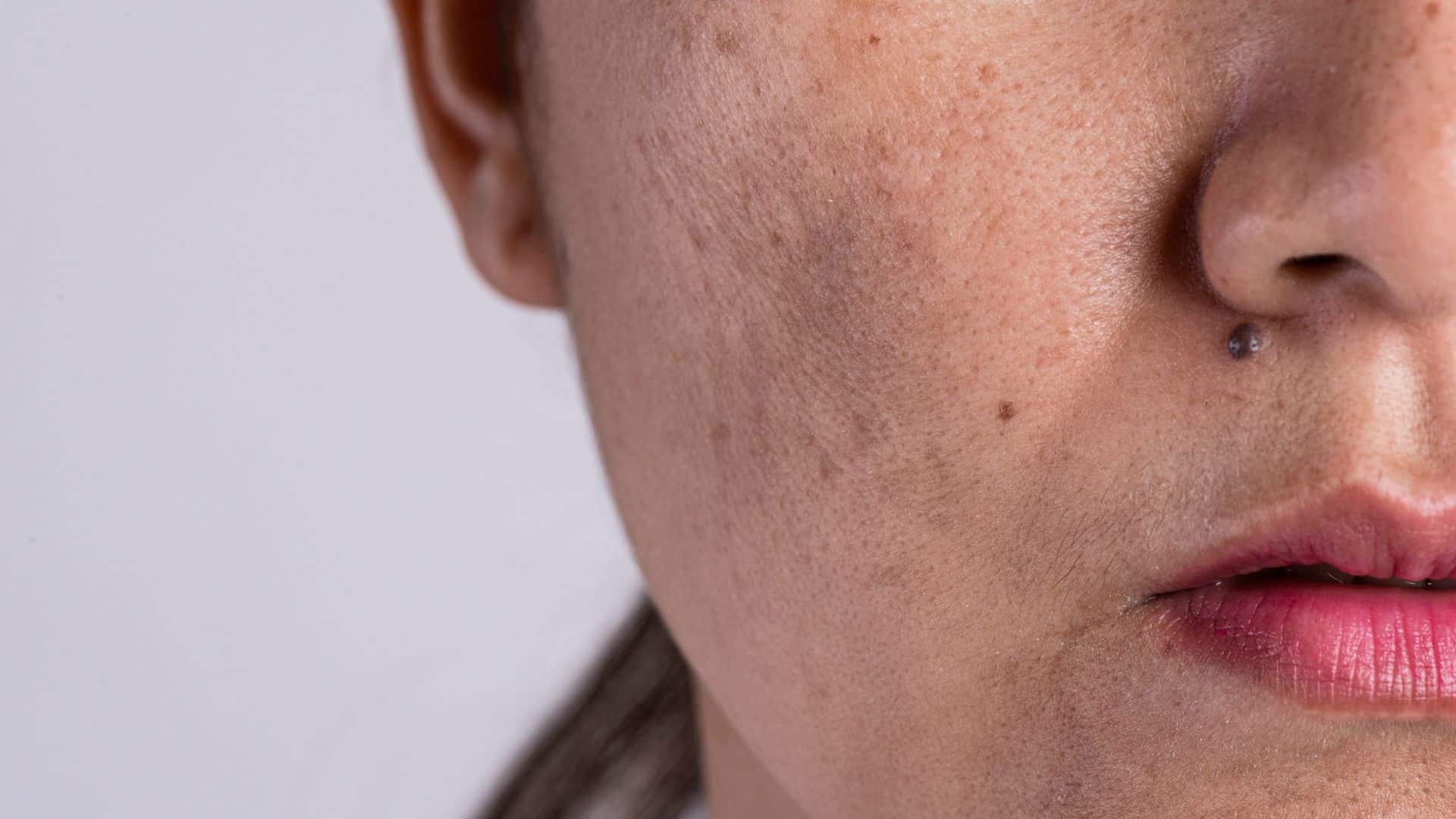 pigmentation-banner