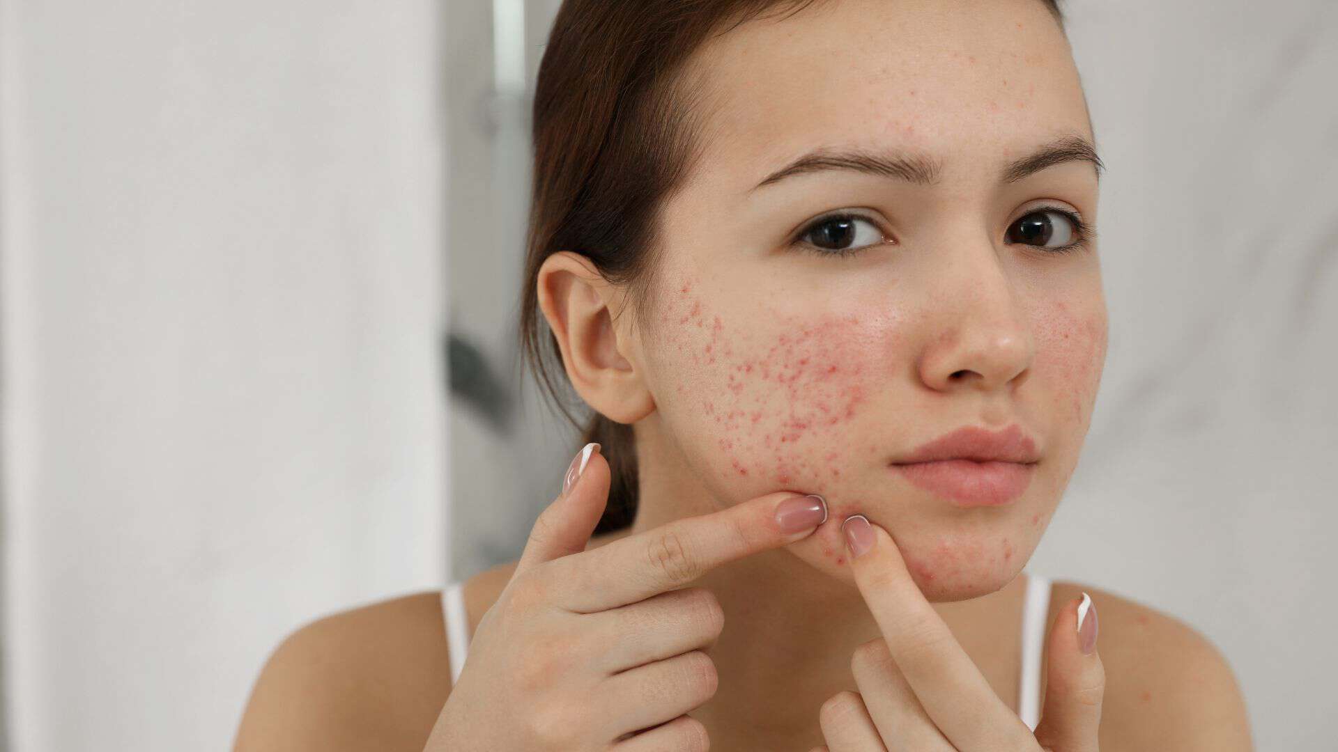Acne-scarring-mirror