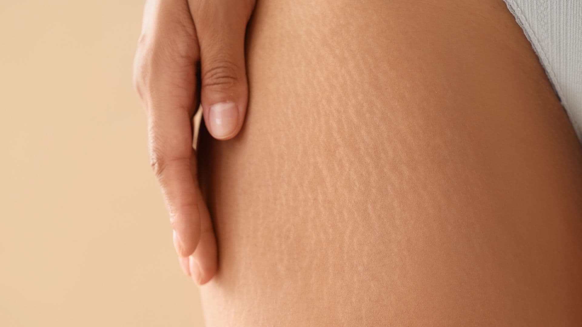 stretch-marks-banner
