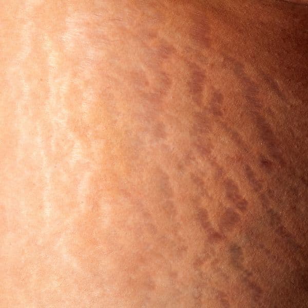 stretch-marks-close