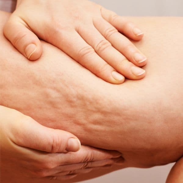 touching-cellulite-thighs