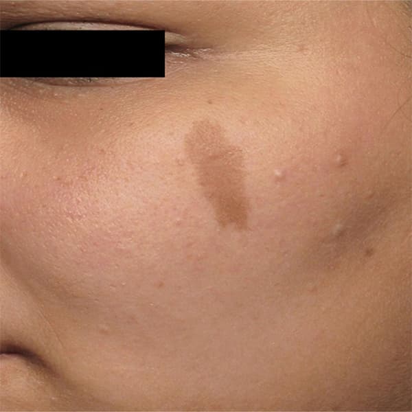 dark-spot-before
