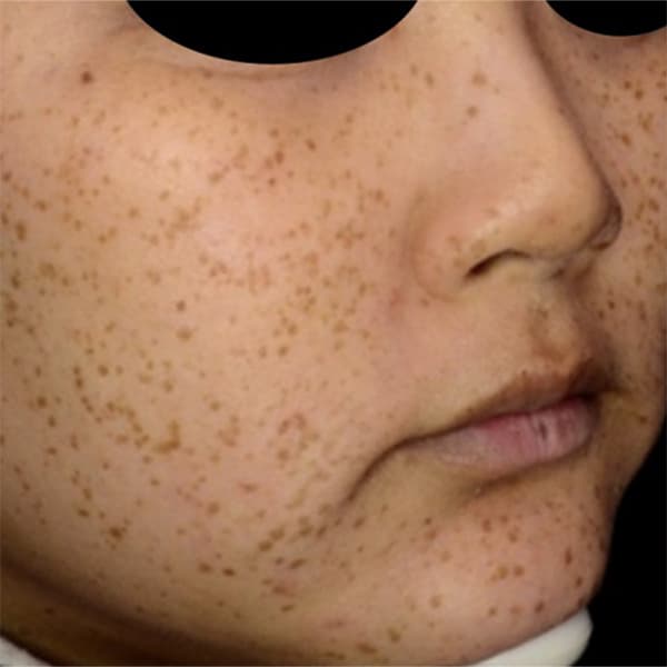 before-picosure-treatment