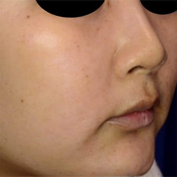 after-picosure-women