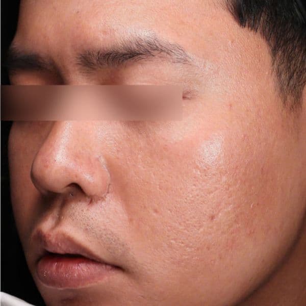 Ultraclear-laser-before