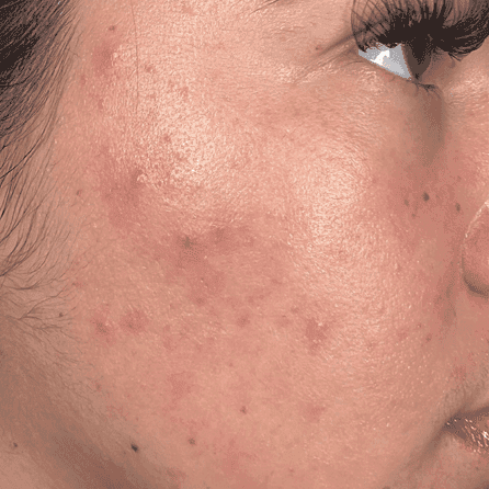 Skin before hydrafacial treatment