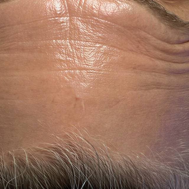 Skin results after hydrafacial treatment