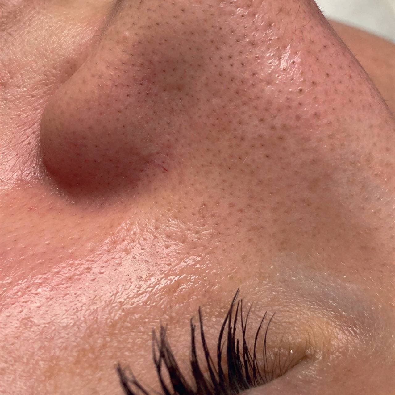 Skin before hydrafacial treatment