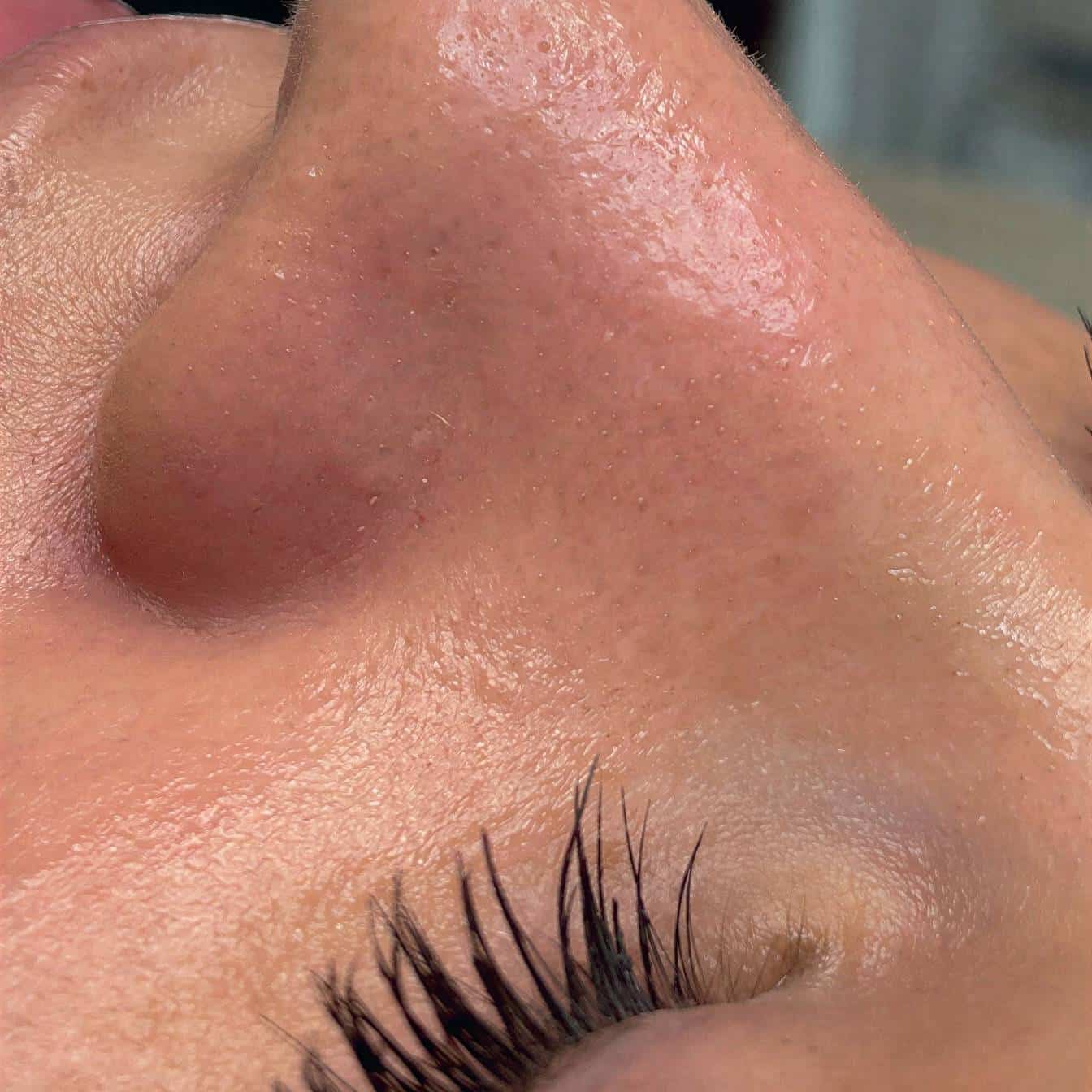 Skin results after hydrafacial treatment