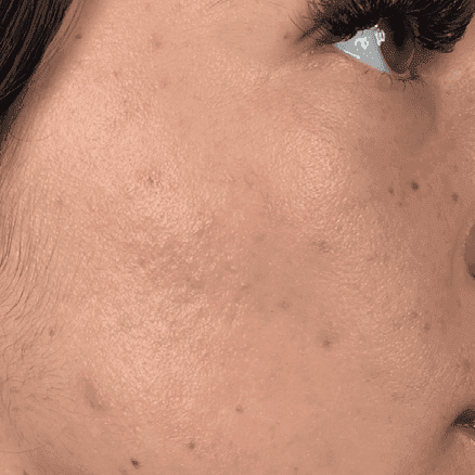 Skin results after hydrafacial treatment