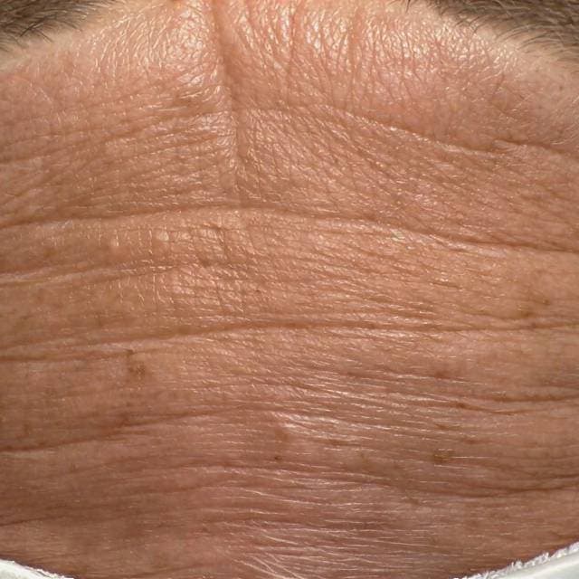 Skin before hydrafacial treatment