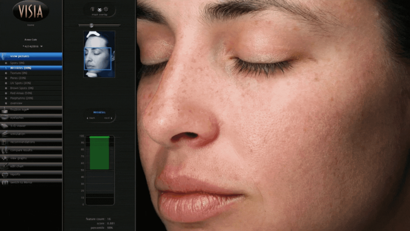 VISIA 7 hyperpigmentation skin analysis comparison