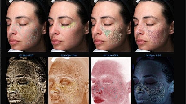 VISIA 7 skin analysis overview screen showing measured skin results