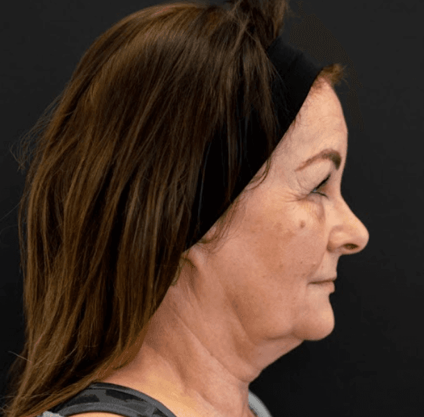 Endolift-before-face-profile