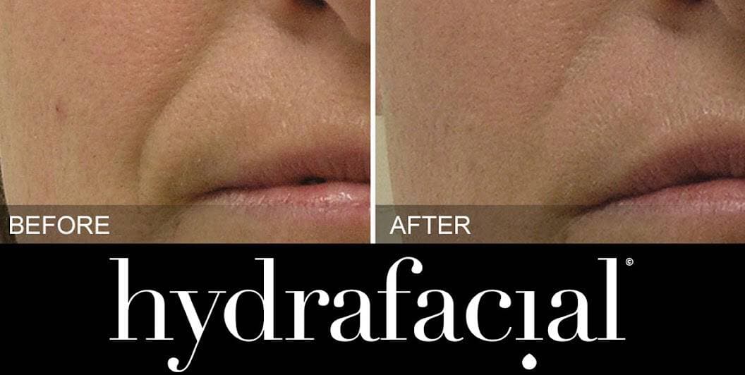 hydrafacial-before-after-lines