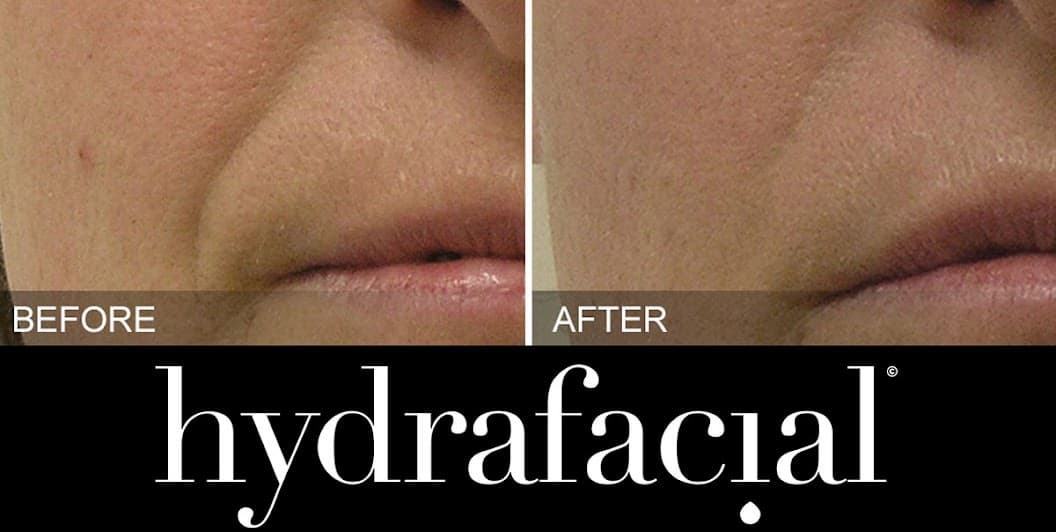 hydrafacial-before-after-lines