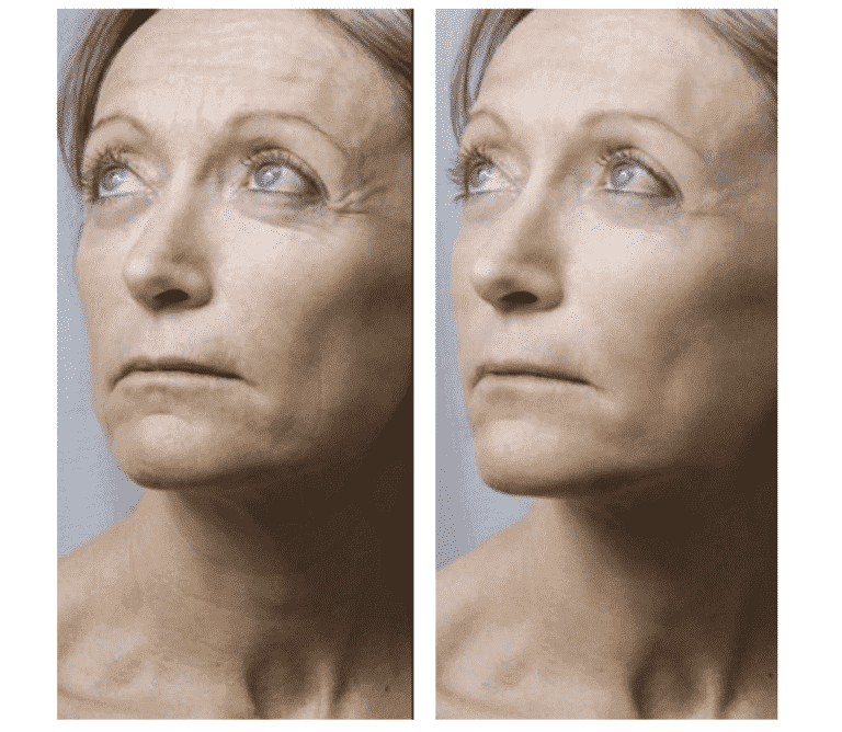Skin-boost-woman-before-after