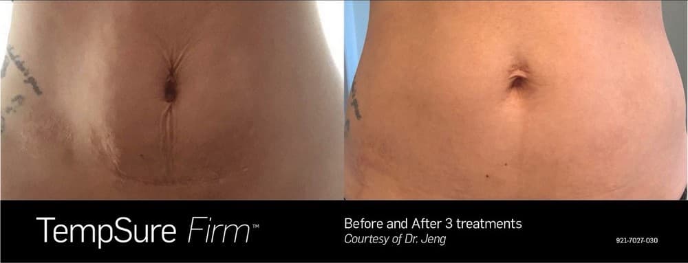 Tempsure-tummy-before-after