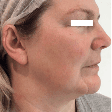 Marina-before-after-face-treatment
