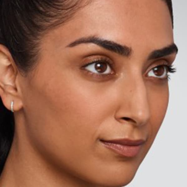 before-juvederm-treatment