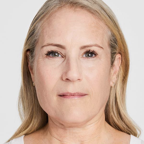 debbie-after-60days-ultherapy