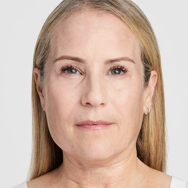 debbie-ultherapy-90days