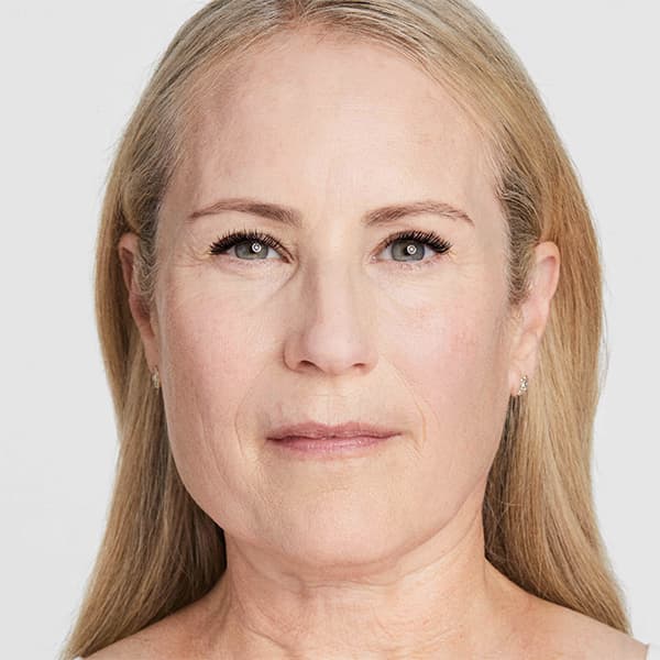 debbie-before-ultherapy