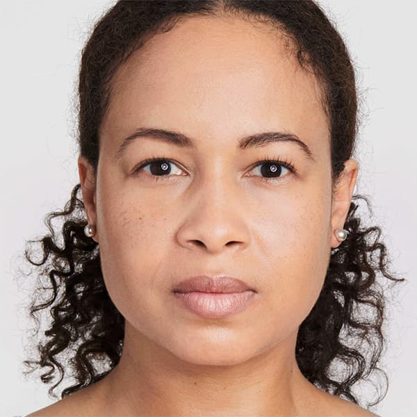 erin-before-ultherapy