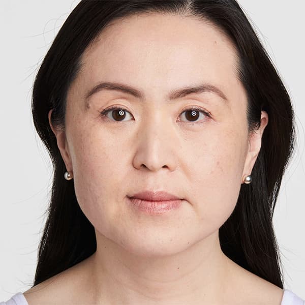 Grace-before-ultherapy