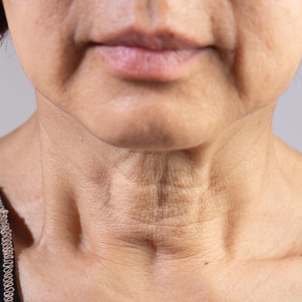 sagging-jawline-close