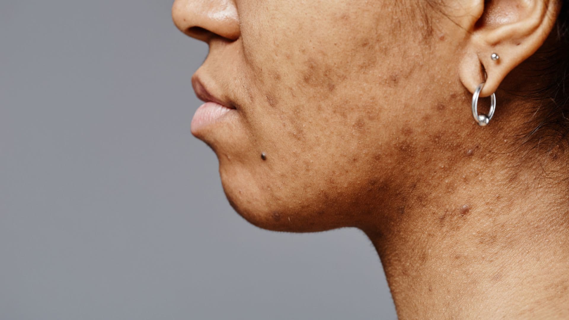 acne-scarring-banner