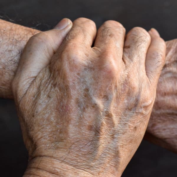 hands-with-age-spots