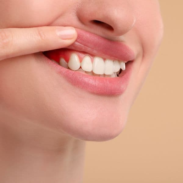 gummy-smile-touching