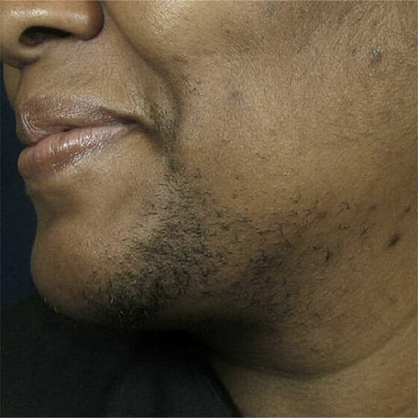 before-male-picosure