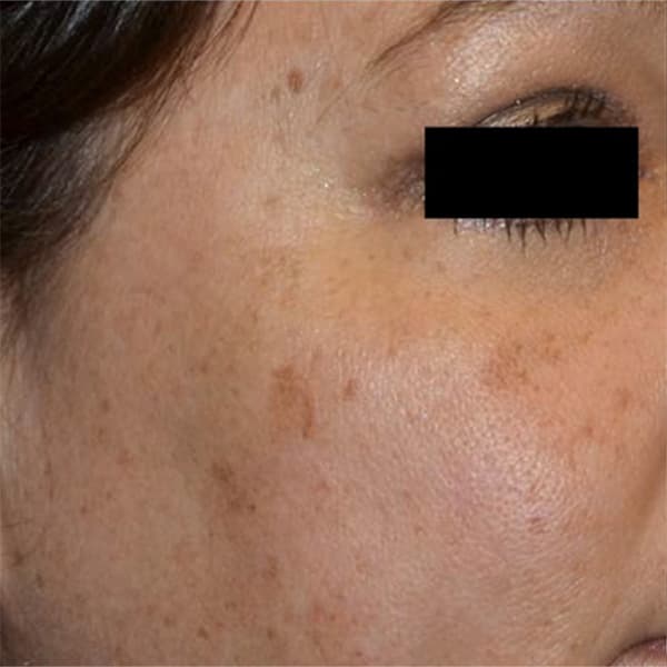 before-picosure-treatment