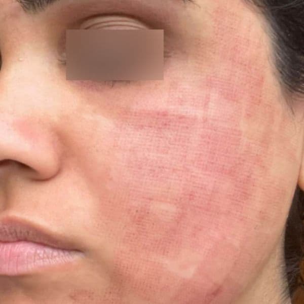 3DMIRACL-After-2-days