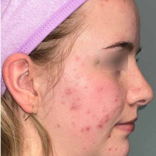 Ultraclear-acne-before