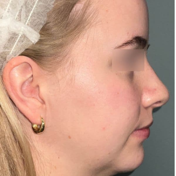 Ultraclear-acne-after