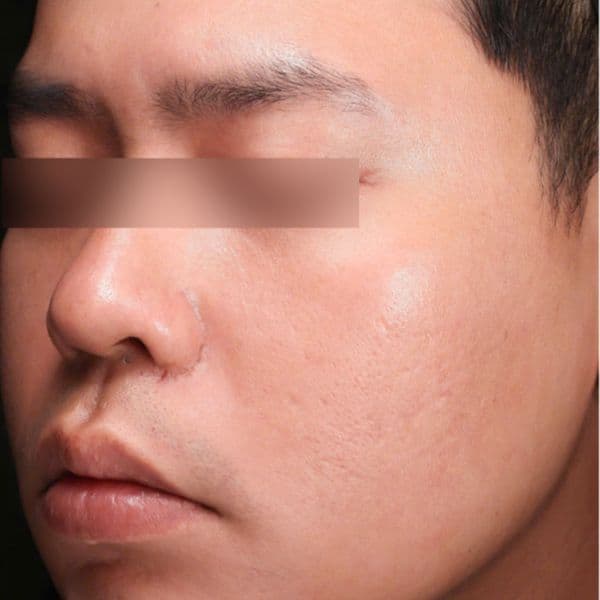 Ultraclear-laser-after