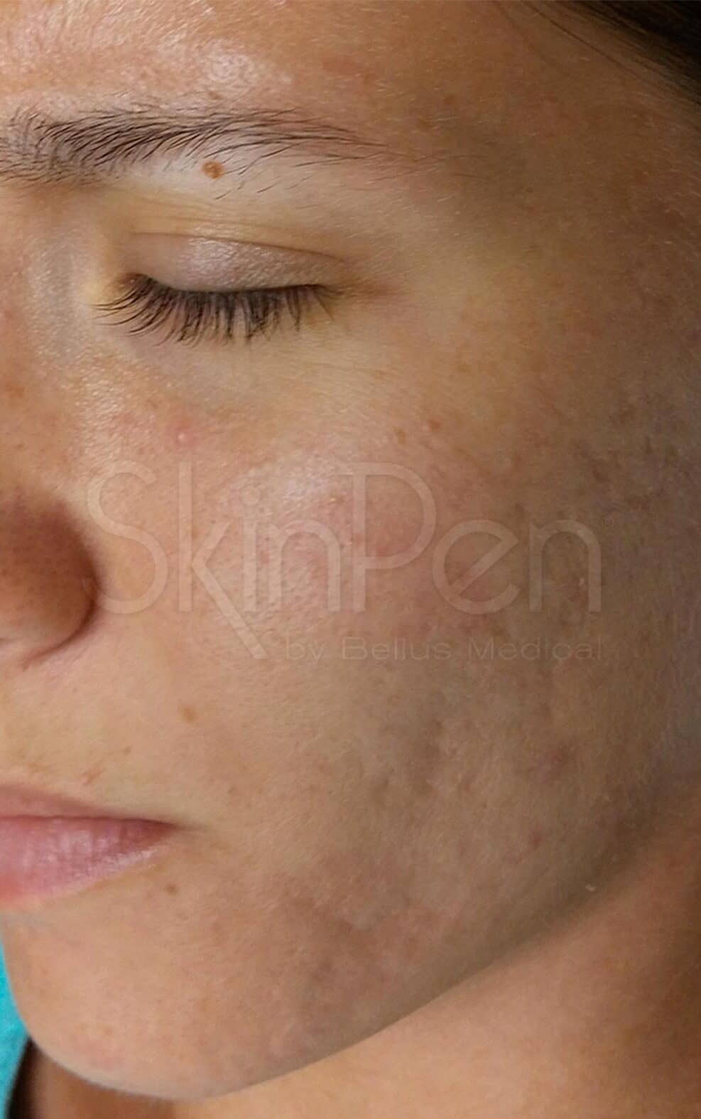 Close-up of a young woman's face showing clear skin after treatment by Dr Joney De Souza.